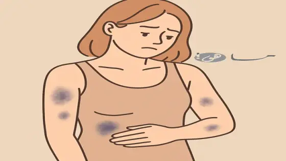 ظهور بقع زرقاء في الجسم عند النساء بدون سبب