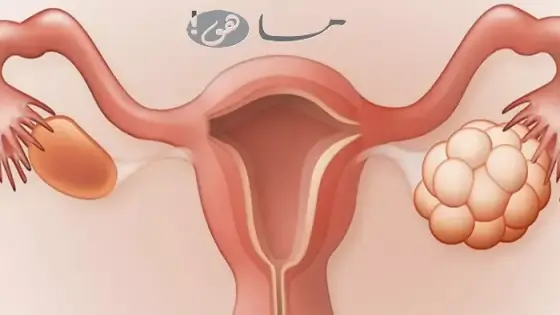 كيف ينزل تكيس المبايض